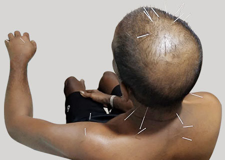 Best Acupuncture Doctors in Hyderabad