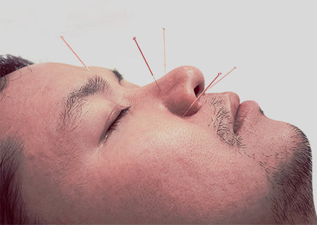 Best Acupuncture Treatment Clinic in Hyderabad